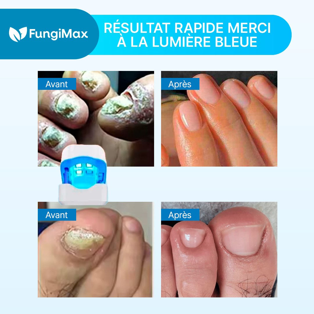 FungiMax - Traitement au Laser Pour la Restauration des Ongles