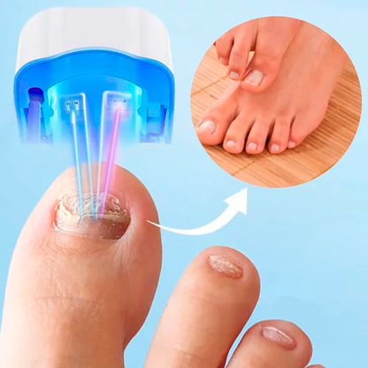 FungiMax - Traitement au Laser Pour la Restauration des Ongles